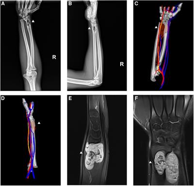 Frontiers Successful Management Of A Rare Radius Schwannoma Mimicking